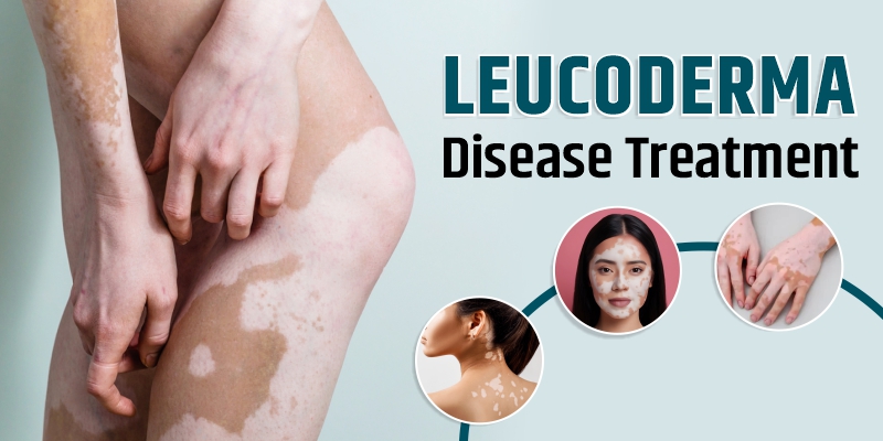 Leucoderma Disease Treatment